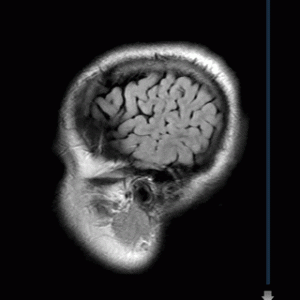 Animated GIF of MR scan